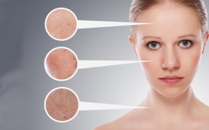 Mách bạn những công thức trị nám da hiệu quả nhất