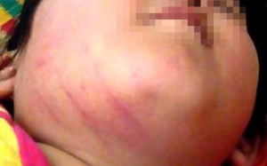 Phụ huynh tố cô giáo dùng thước gỗ đánh bầm mặt trẻ