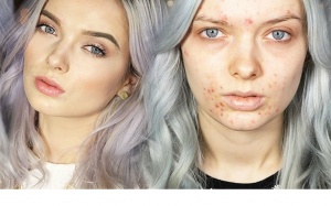 Vạch mặt hung thủ không ai ngờ khiến phái đẹp hay bị mụn