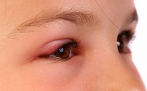 Mắt sưng, chảy nước nước mắt là do đâu?