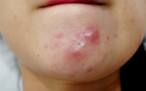 4 cách xóa sạch mụn trứng cá dạng nang nhanh gọn