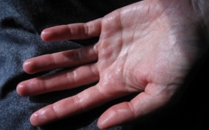 Ra mồ hôi tay chân nhiều năm phải điều trị như thế nào?