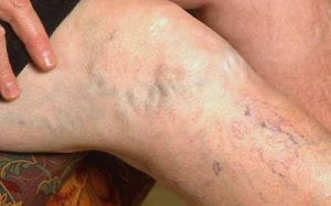 Chân nổi nhiều gân xanh: Chớ dại mà chủ quan!