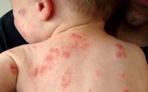 Cho trẻ bôi kem Subạc vào vết thương hở có nguy hiểm không?