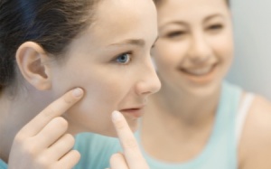 Kem thảo dược Azacne có trị được mụn?