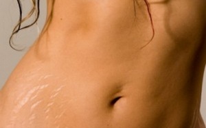 Chưa mang thai nhưng vẫn bị rạn da vì sao?