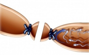 Chồng thắt ống dẫn tinh vợ vẫn có bầu