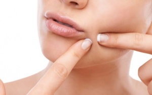6 cách trị mụn trứng cá tuyệt đối không nên thử