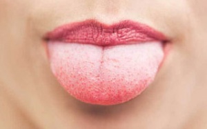 Liệu pháp chữa bệnh tưa tại nhà