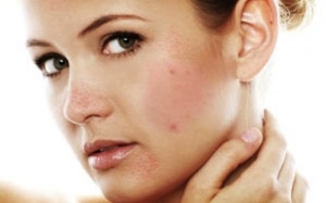 Cải thiện làn da đầy mụn trứng cá với sản phẩm thảo dược