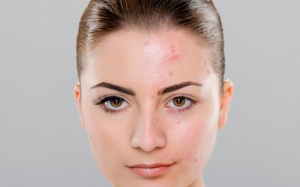 6 loại thuốc có thể là nguyên nhân gây mụn trứng cá