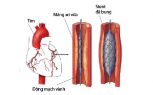 Sau khi đặt stent có được dùng TPCN Vương Tâm Thống?
