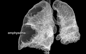 Các phương pháp phẫu thuật cho bệnh nhân khí phế thũng
