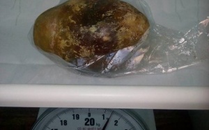 Hy hữu viên sỏi bàng quang nặng 1,5kg