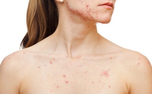 Mụn trứng cá có lây lan không?