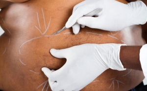 Điều trị đái tháo đường type 2 bằng phẫu thuật giảm cân