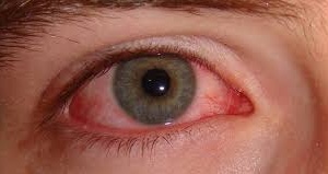 Chưa chữa xong tăng nhãn áp thì bị rối loạn cương dương