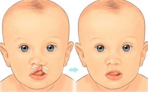 Điều trị hở hàm ếch như thế nào?