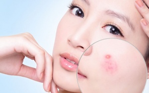 5 cách loại bỏ mụn nhọn đơn giản đến bất ngờ