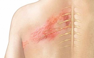 Bệnh zona thần kinh có lây không?