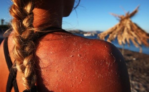 Phải làm gì khi bị say nắng, bỏng nắng nặng?