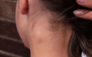 Liệu pháp chữa sưng hạch bạch huyết không cần kháng sinh