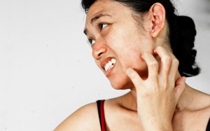 Ngứa, nổi đốm đỏ trên mặt và bàn tay khi ra nắng là bệnh gì?