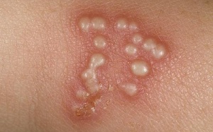 10 cách chữa Herpes sinh dục đơn giản tại nhà