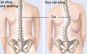 Làm gì khi bị cong vẹo cột sống?