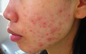 Nhận biết nguy cơ nhiễm độc kim loại qua những biểu hiện trên da