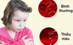 Bé da xanh - coi chừng thiếu máu