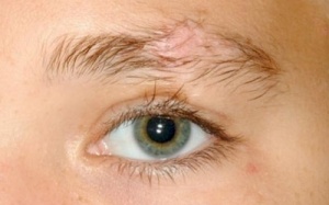 Phải làm gì khi lông mày bị rụng nhiều?