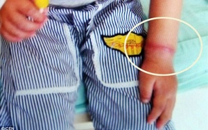 Cảnh báo: Cậu bé 4 tuổi suýt bị cắt tay vì một chiếc vòng chun