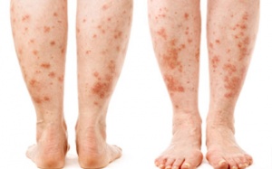  Bệnh nhân vẩy nến cần cẩn trọng khi dùng những loại thuốc này!