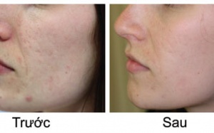Bí quyết làm mờ thâm sẹo do mụn chỉ sau 1 tuần