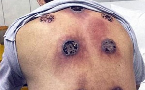 Loét lưng, suýt nhiễm trùng huyết vì giác hơi