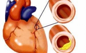 Hẹp động mạch vành nên điều trị thế nào?