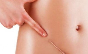 Nữ sinh được đặc cách tốt nghiệp vì viêm ruột thừa