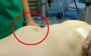 Những điều bạn cần biết về phình động mạch chủ