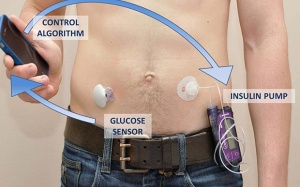 'Tuyến tuỵ nhân tạo' giúp bệnh nhân đái tháo đường sống như người thường