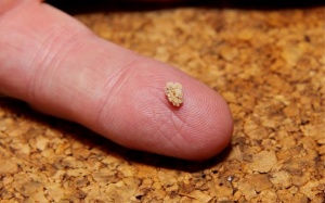 Có cách nào ngăn ngừa sỏi thận tái phát?