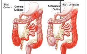 Đừng để bị bệnh đại tràng nặng mới lo chạy chữa.