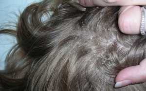 Phương pháp điều trị tự nhiên cho nấm da đầu