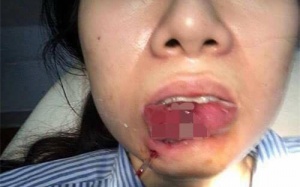 Xót xa cô gái Quảng Ninh phải cắt bỏ môi sau khi tiêm chất làm đầy