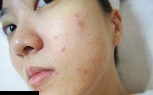 Da bị nổi mụn và ngứa do đâu?