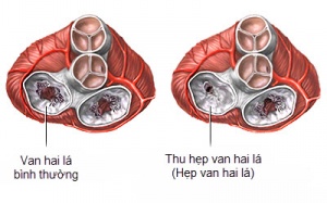 Hẹp van 2 lá có phải do di truyền?