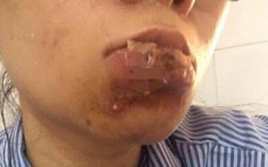 Đáng sợ chất làm đầy trôi nổi