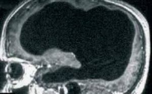 Người đàn ông sống khỏe dù mất 90% não khiến y học bối rối