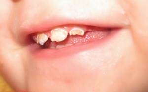 Các vấn đề về răng miệng của trẻ cha mẹ cần biết