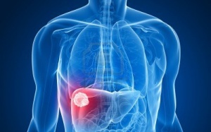 Các dấu hiệu sớm cần biết về ung thư gan